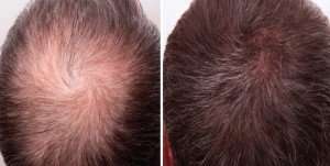 Microneedling-Hairloss-- before and after