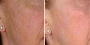 Microneedling-Pigmentation- before and after