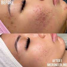 acne+pic before and after