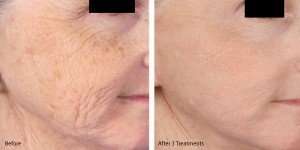 cheeks+microneedling-with-prp-before-and-after-