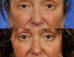 eyes+microneedling-before-after-