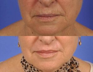 mouth+microneedling-before-after